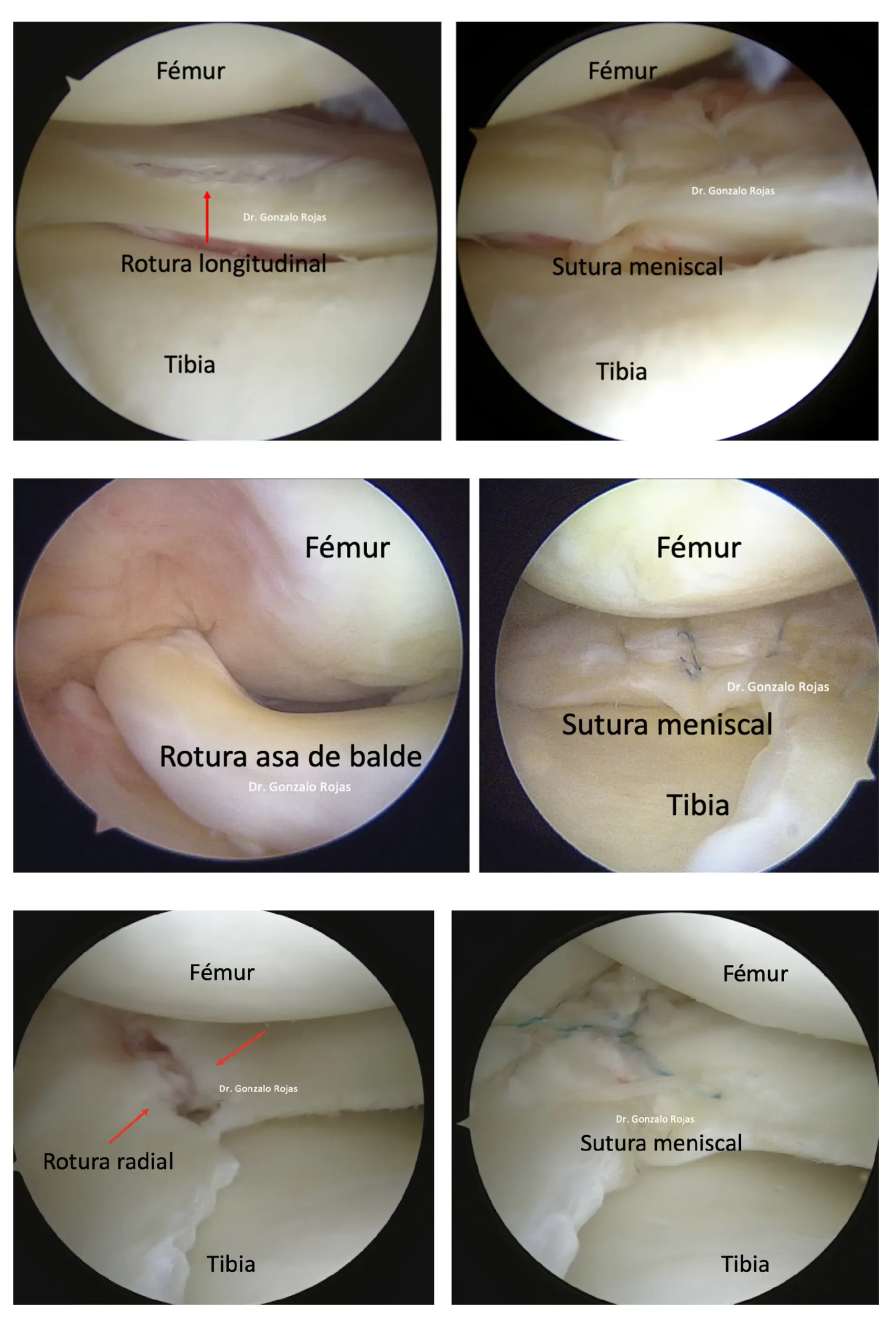 suturas de menisco de rodilla